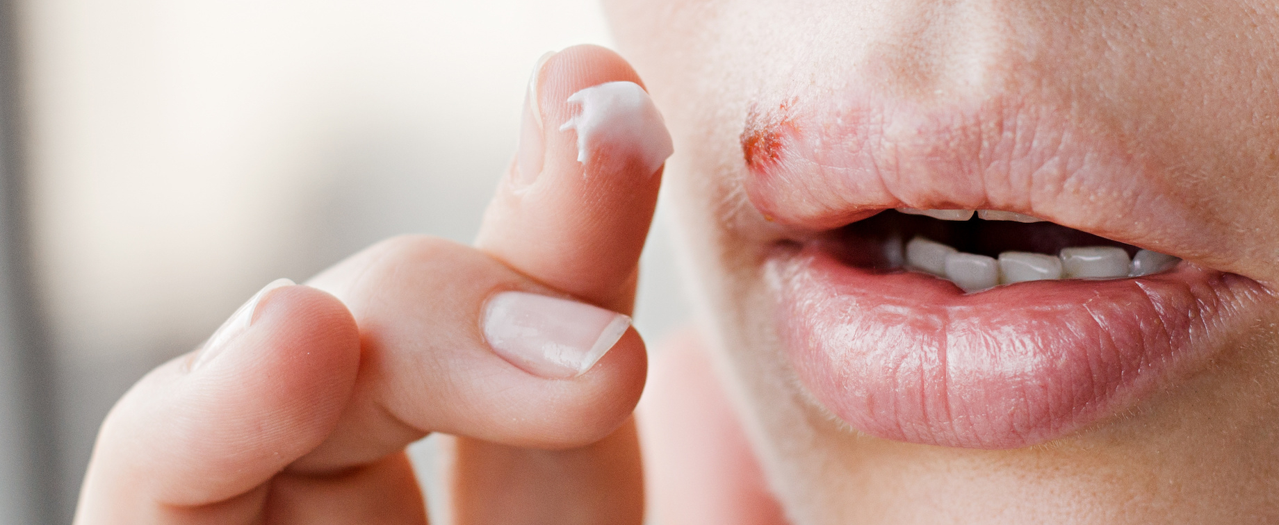 What are the symptoms risk factors and treatments for viral herpes 