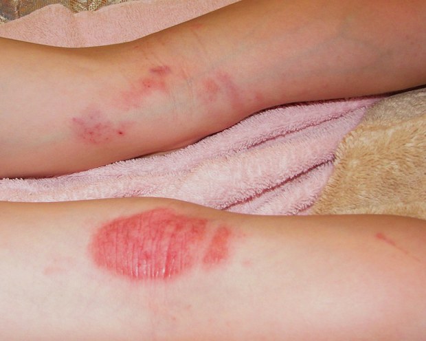 Eczema rashes on the back of legs
