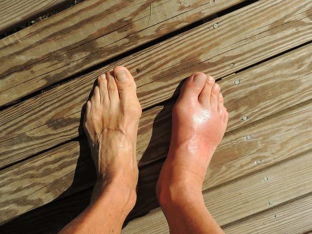 a pair of feet with one foot red and swollen with gout