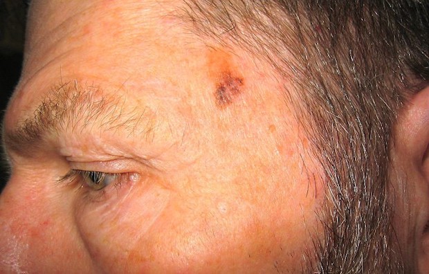 A man with a melanoma growth on the side of his head