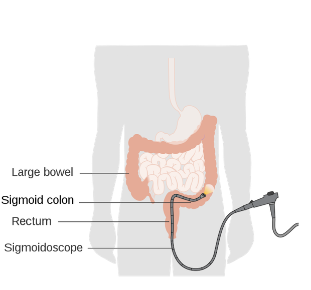 a diagram of a sigmoidoscopy being inserted into the colon