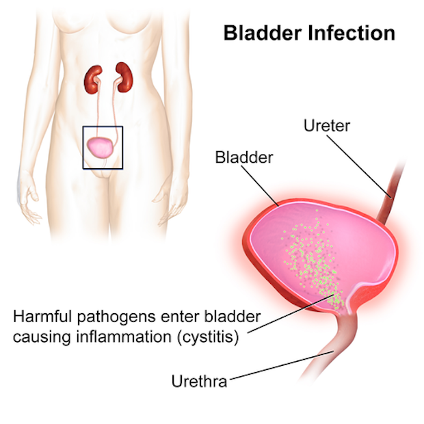 diagram of a bladder infection