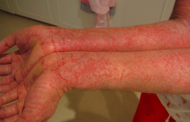 Two arms side by side with eczema