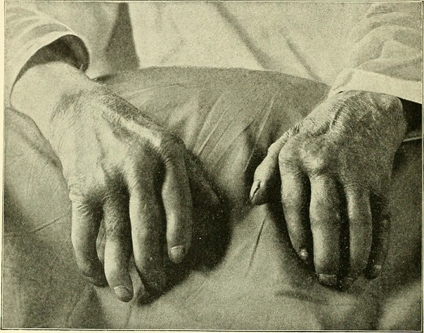 a person’s hands affected by gout and deformed joints