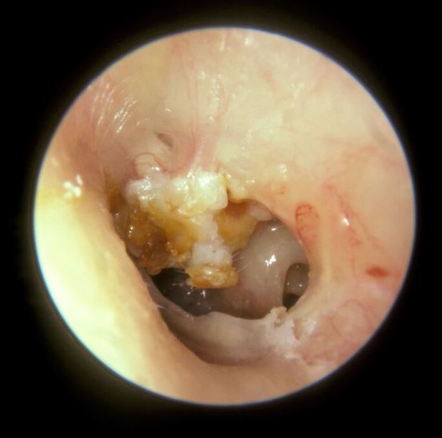 a cholesteatoma in the ear