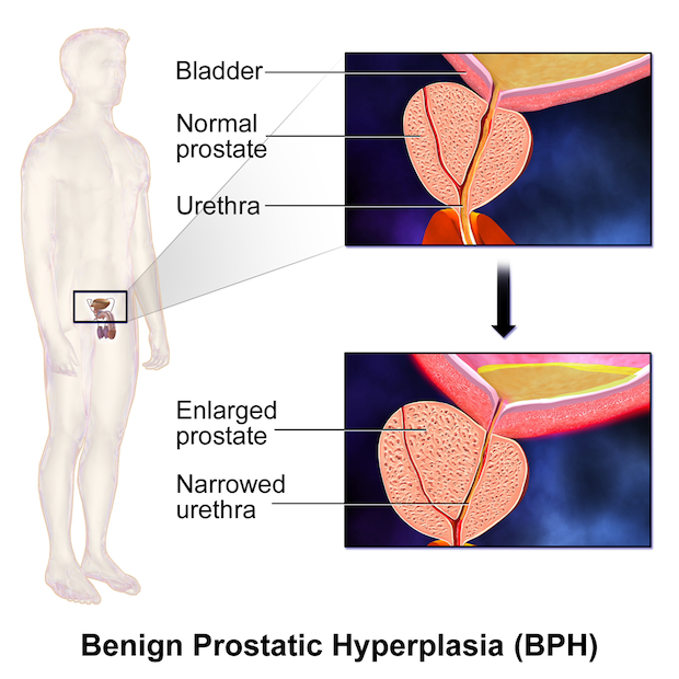 a diagram of an enlarged prostate