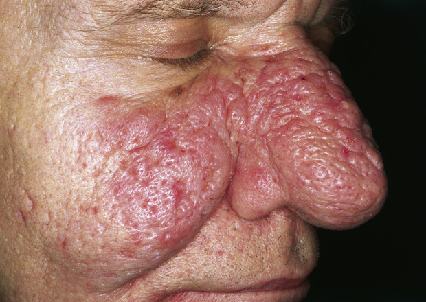 A man showing rosacea redness and bulbous nose
