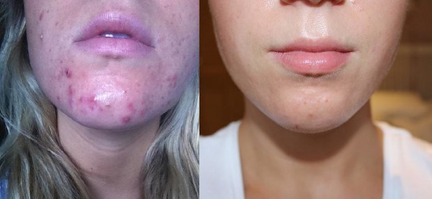 a woman before and after with acne on her chin