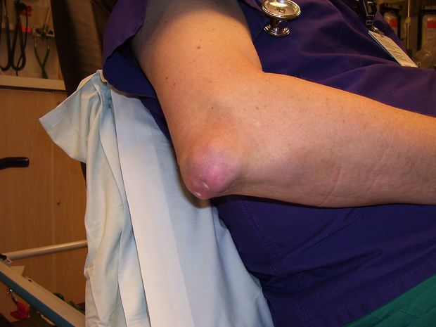a person with tophaceous gout on their elbow