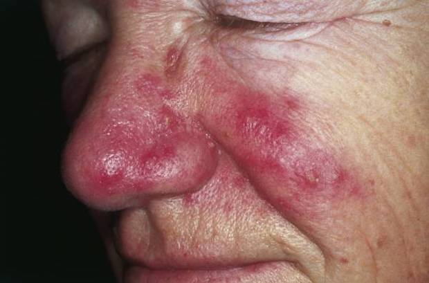 Red blemishes on the cheeks and nose caused by rosacea