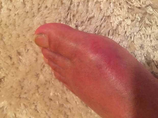 a swollen foot inflamed with gout