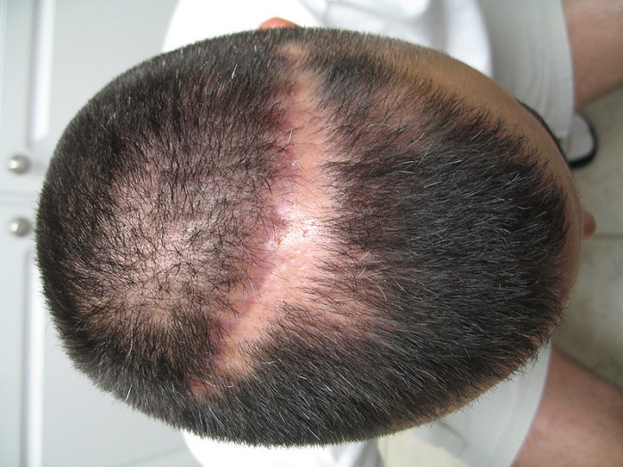 image of scarred scalp