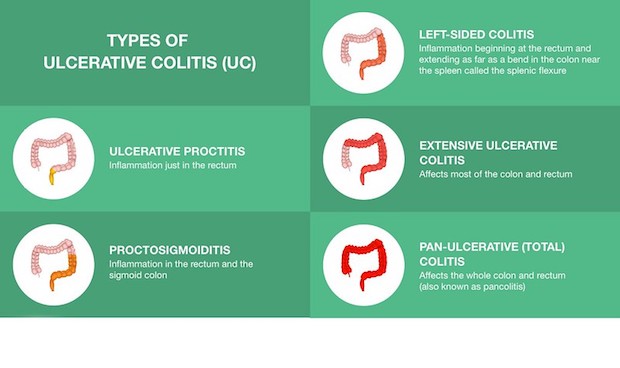 a diagram showing the different types of colitis 