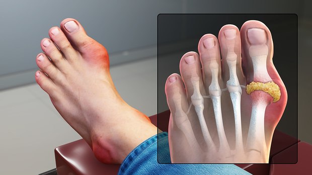 an image displaying the inflammation of gout in the big toe