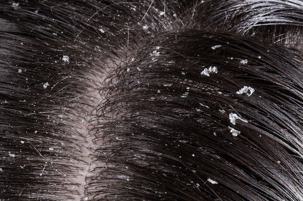 a close up view of dandruff flakes in black hair