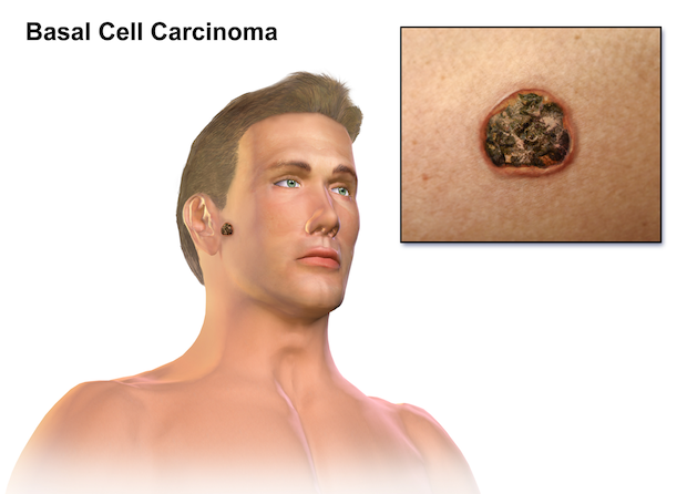 An illustration of a BCC growth on the face